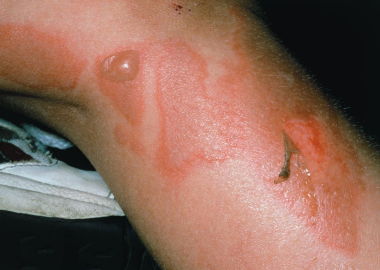 <p>What staphylococcus aureus skin infection is shown?</p>