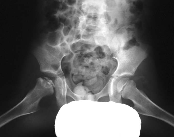<p>Crescent sign – subcortical radiolucent band representing a fracture line.</p>