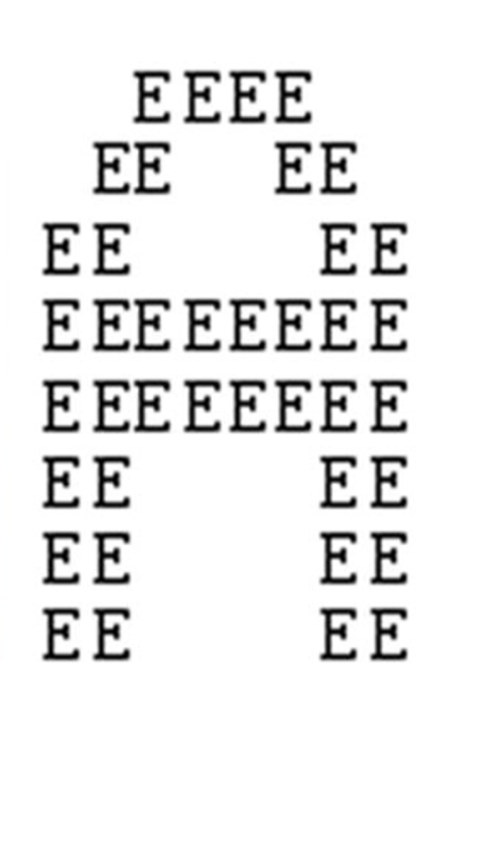 <p>A rare disorder associated with deficits in processing multiple objects or features of objects together. “a patients world unglued” cannot bring coherence to the world. they cannot see an A made up of E's, just a bunch of E's. cannot globally process <span style="background-color: transparent;"><span>When seeing a drawing of a bunch of different objects drawn on top of one another, they will only be able to see one of the objects. If they see a circle with a bunch of diagonal lines, they will only be able to see diagonal lines or a circle, not a circle with diagonal lines</span></span></p><p>these people have a majority of their brain damage in the gestalt cortex</p>