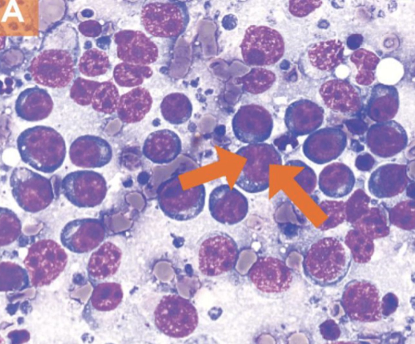 <p>You aspirate a swollen lymph node and examine it under the microscope. What do you see?</p>