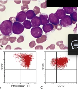 <ul><li><p>Neoplasms that cause <span style="color: red">uncontrolled proliferation of immature B and T cells (lymphocytes)</span> → most are B cells (B-ALL) → most common cancer in children</p></li><li><p>Caused by gene aberrations in transcription factors for B and T cell development</p></li><li><p>Clinical Manifestations:</p><ul><li><p><span style="color: red">Hypercellular Bone Marrow</span> packed with more than 20% lymphoblasts that have condensed chromatin, small nucleoli and are agranular</p></li><li><p>Fatigue, fever, Bleeding, Testicular enlargement, CNS manifestations, headache, vomiting, nerve palsies</p></li></ul></li><li><p>B cells have CD22, CD10 and CD19+ markers, while T cells have CD1, CD2, <span style="color: red">CD5</span> and CD7</p></li></ul><p></p>