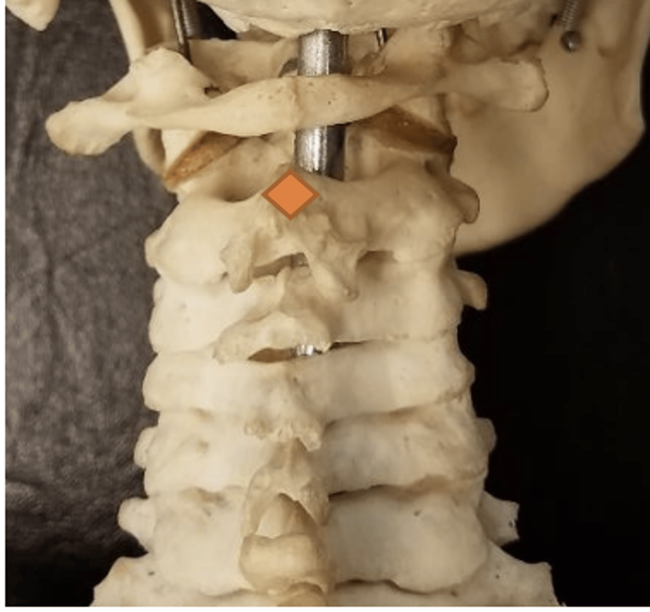 <p>superior aspect of spinous processes of C2</p>