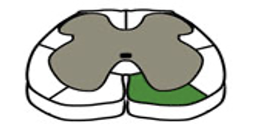 <p>VF fill at L6/S1</p>