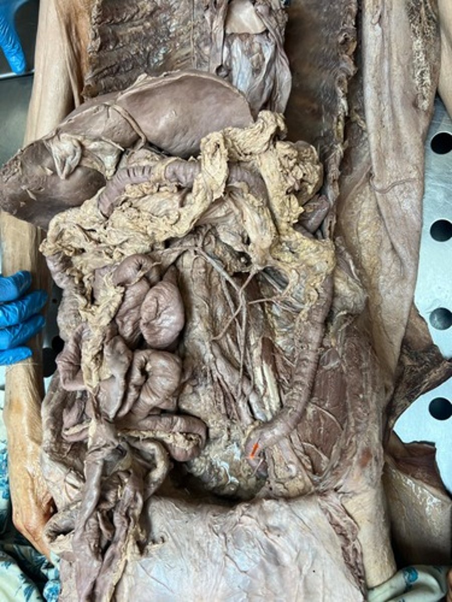 <p>Sigmoid colon</p>