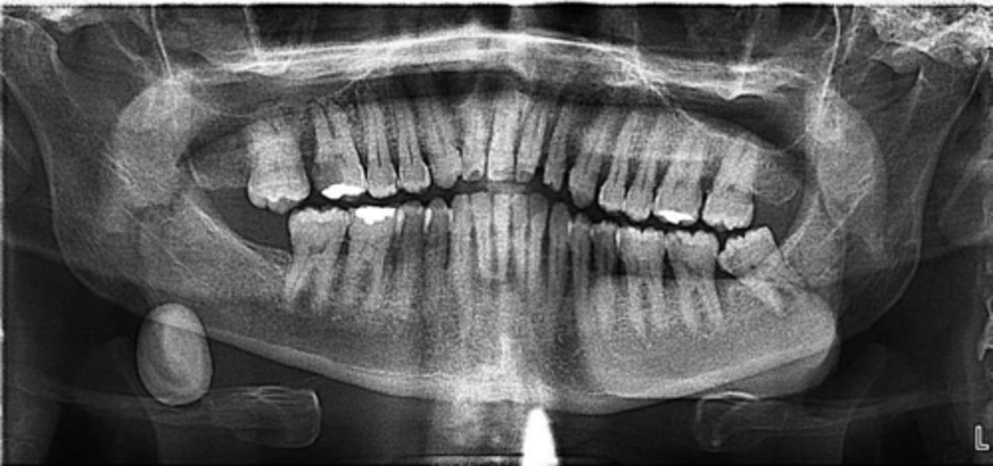 <p>ID the pathology:</p>