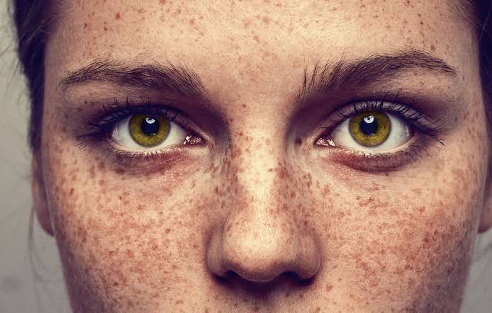<p>Ephelides/Freckles are caused by <strong><em><em></em></strong></em>__ clusters that are aggravated by the sun.</p>