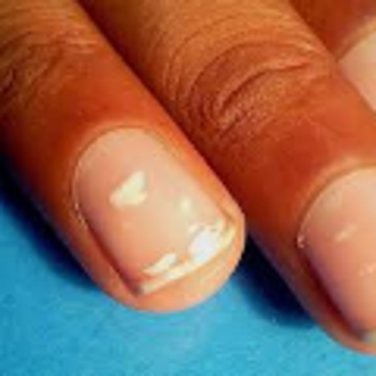 <p>-White spots on the nail</p><p>-people with anemia</p>