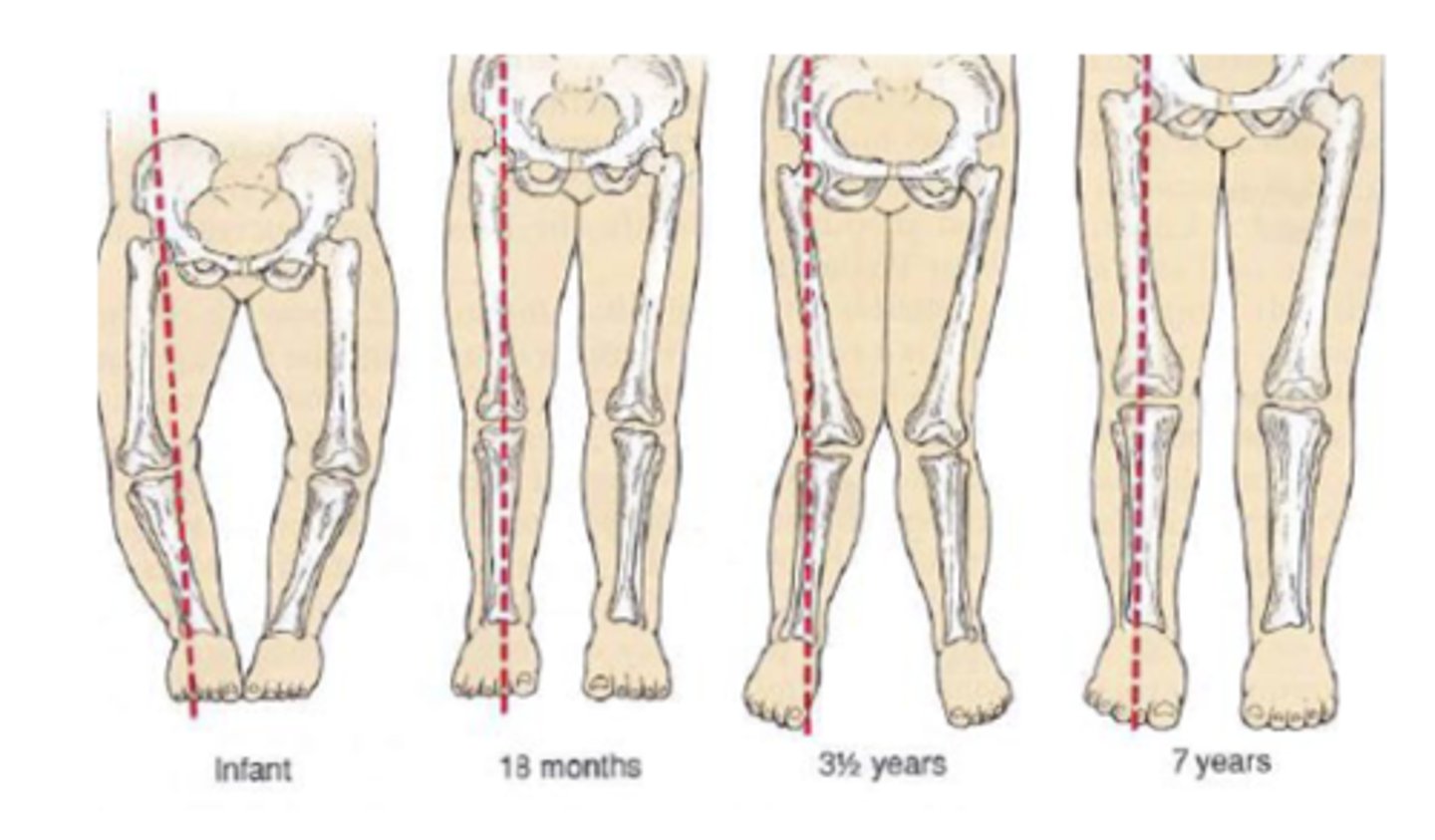 <p>outward bowing of knees (>1 in.) when medial malleoli are touching.</p><p>-- May require bracing after 2 years old</p>