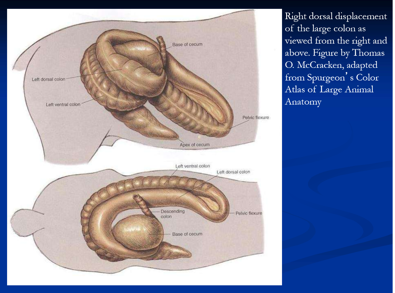 <ul><li><p>the figure shows a complete right dorsal displacement of the LC </p></li><li><p>the large <strong>colon is displaced between the cecum and right body wall and wrapped around the back of the cecum, </strong>running transversally across the caudal aspect from right to left with the pelvic flexure directed forward </p></li><li><p>partial or incomplete displacements are often found at laparotomy </p></li><li><p>may possibly progress to torsion and or volvulus </p></li><li><p>a <strong>non-strangulating displacement resulting in progressive signs of pain </strong>and abdominal distention </p><ul><li><p>pain varies depending on the position of the colon and degree of gas distention </p></li><li><p>over time, distention progresses, the levels of pain and cardiovascular compromise increase, and the colon is vulnerable to volvulus </p></li></ul></li><li><p>dx: pain, distention, lack of fecal production, <strong>abnormal rectal exam; </strong>often the colon can be clearly felt passing across the caudal-dorsal aspect of cecum; ultrasound </p></li><li><p><strong>surgical correction is required; </strong>generally good prognosis </p></li></ul><p></p>