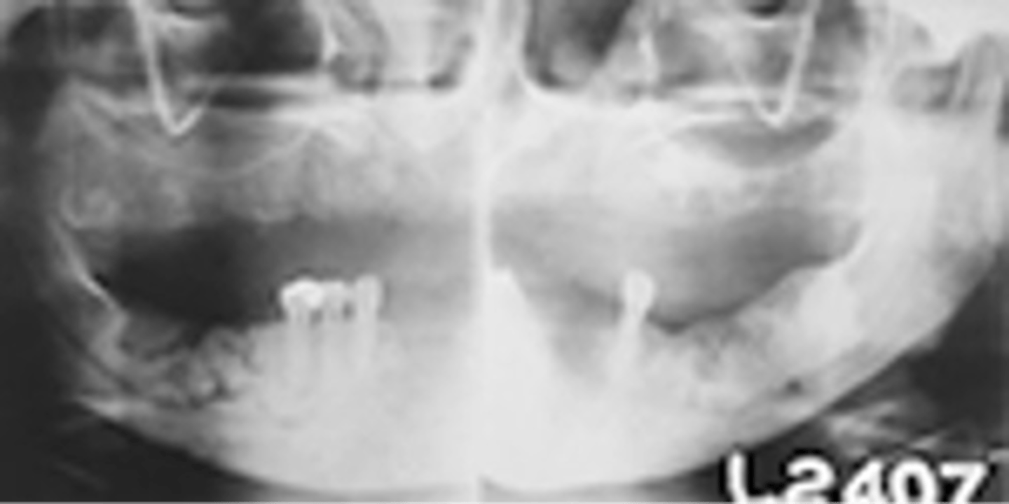 <p>exuberant form of periapical cemento-osseous dysplasia, may involve entire jaw, African American middle aged women</p>