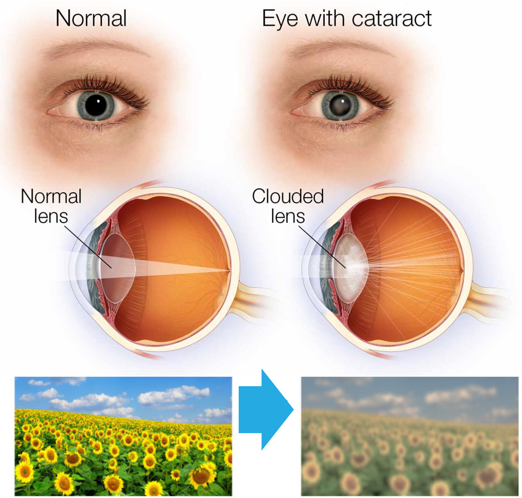 <p>cataracts vs glaucoma vs macular degeneration</p>