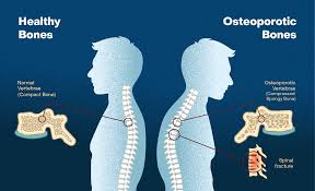 <p>Osteoporosis </p>