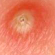 <p>pustule</p>