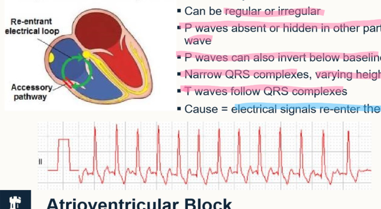 <ol><li><p>tachycardia - fast</p></li><li><p>can be regular or irregular</p></li><li><p>P waves absent/hidden in another part of the wave</p><ul><li><p>P waves can be inverted below the baseline</p></li><li><p>narrow QRS complexes, varying heights</p></li><li><p>T waves follow QRS complexes</p></li></ul></li><li><p>Cause = electrical signals re-enter atria (go along an abnormal pathway which constantly stimulates atrial systole)</p><ul><li><p>the green circle represents this</p></li></ul></li></ol><p></p>