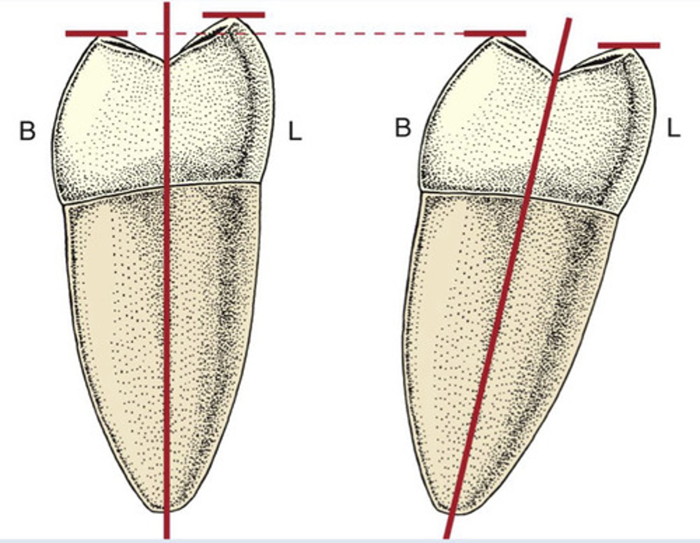 <p>yes, if it is held straight on its vertical midroot axis</p><p>-appears nearly level in the mouth due to the lingual tilt of the molar</p>
