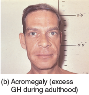 <p>Excessive growth hormone production in adults, causing bone and tissue overgrowth. - A person will have crude facial features, large jaws, heavy forehead, large nose, lips and ears.</p>