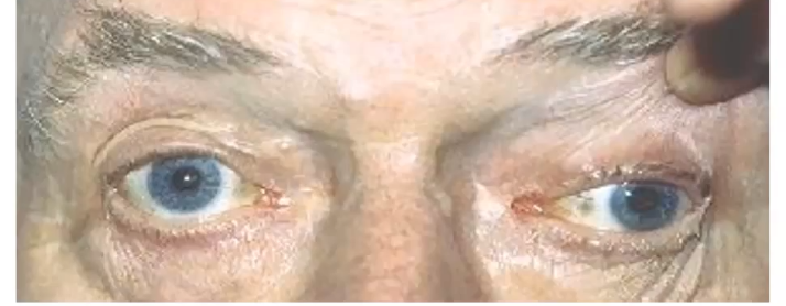 <p>third nerve palsy </p>