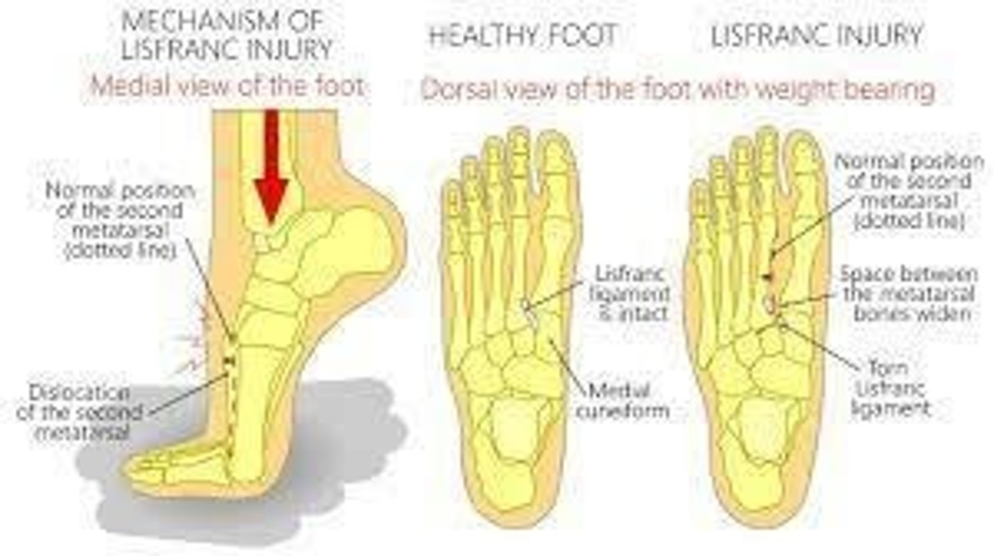 <p>An injury to the midfoot supportive ligaments (Lisfranc complex) with or without associated fractures.</p>