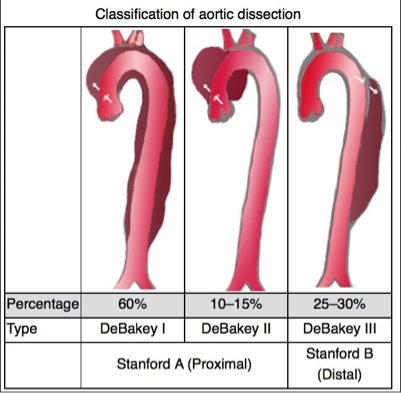 <p>Involves the Ascending aorta</p>
