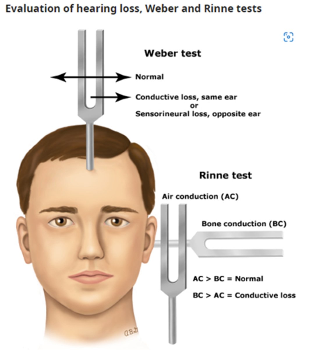 <p>Normal= no lateralization<br><br>Conductive hearing loss= lateralization to affected side</p>