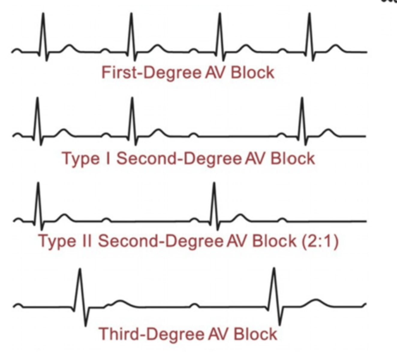 <p>Conduction delay in area of AV conduction system <br><br>Prolonged PR Interval, each type is progressively longer</p>