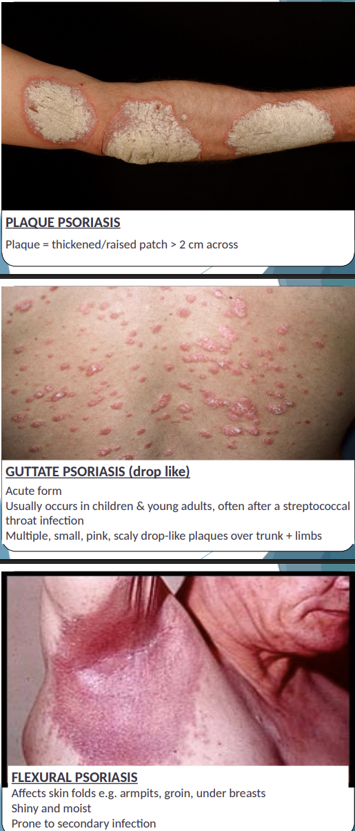 <p><strong><mark data-color="purple" style="background-color: purple; color: inherit"><u>CHRONIC PLAQUE PSORIASIS: </u></mark><u>- MAIN ONE</u></strong></p><ul><li><p><strong><mark data-color="blue" style="background-color: blue; color: inherit">Plaque = thickened/raised patch &gt; 2 cm across</mark></strong></p></li><li><p><mark data-color="blue" style="background-color: blue; color: inherit">Red plaques</mark> – well defined edge covered with <mark data-color="blue" style="background-color: blue; color: inherit">silvery scales</mark></p></li><li><p>Plaques can be any size </p></li><li><p><mark data-color="red" style="background-color: red; color: inherit">Scale = flakes of stratum corneum, accumulate or shed</mark></p></li><li><p>Can affect any area (usually scalp, kness/shins, outside of elbows, lower back)</p></li><li><p>Plaques can crack and bleed – scratching/removing scales → pinpoint bleeding</p></li><li><p>Usually symmetrical in distribution across the body</p></li></ul><p></p><p><strong><mark data-color="purple" style="background-color: purple; color: inherit"><u>GUTTATE PSORIASIS (drop like</u></mark></strong><mark data-color="purple" style="background-color: purple; color: inherit">)</mark><strong><mark data-color="purple" style="background-color: purple; color: inherit"><u>:</u></mark></strong></p><ul><li><p>Acute</p></li><li><p>Children and young adults usually</p></li><li><p>Often after a streptococcal throat infection</p></li><li><p>Multiple, small, pink, scaly drop-like plaques over trunk + limbs</p></li></ul><p></p><p><strong><mark data-color="purple" style="background-color: purple; color: inherit"><u>FLEXURAL PSORIASIS:</u></mark></strong></p><ul><li><p>Affects skin folds e.g. armpits, groin, under breasts</p></li><li><p>Shiny and moist</p></li><li><p>Prone to secondary infection</p></li></ul><p></p>