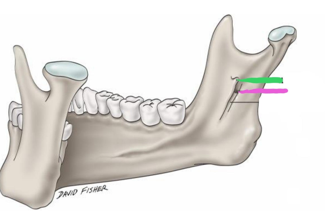 <p>The _________(green) is located on inner surface of ramus; elevation of bone which protects entrance of _________(pink)<strong>&nbsp;</strong>(opening)</p>