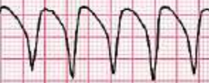 <p>Which cardiac rhythm is shown?</p>