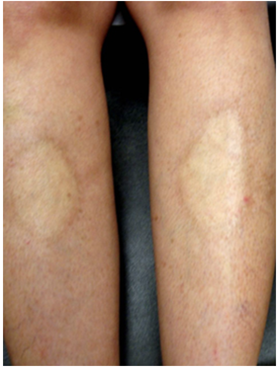 <p>Types of localized (skin only) scleroderma (Morphea)</p>