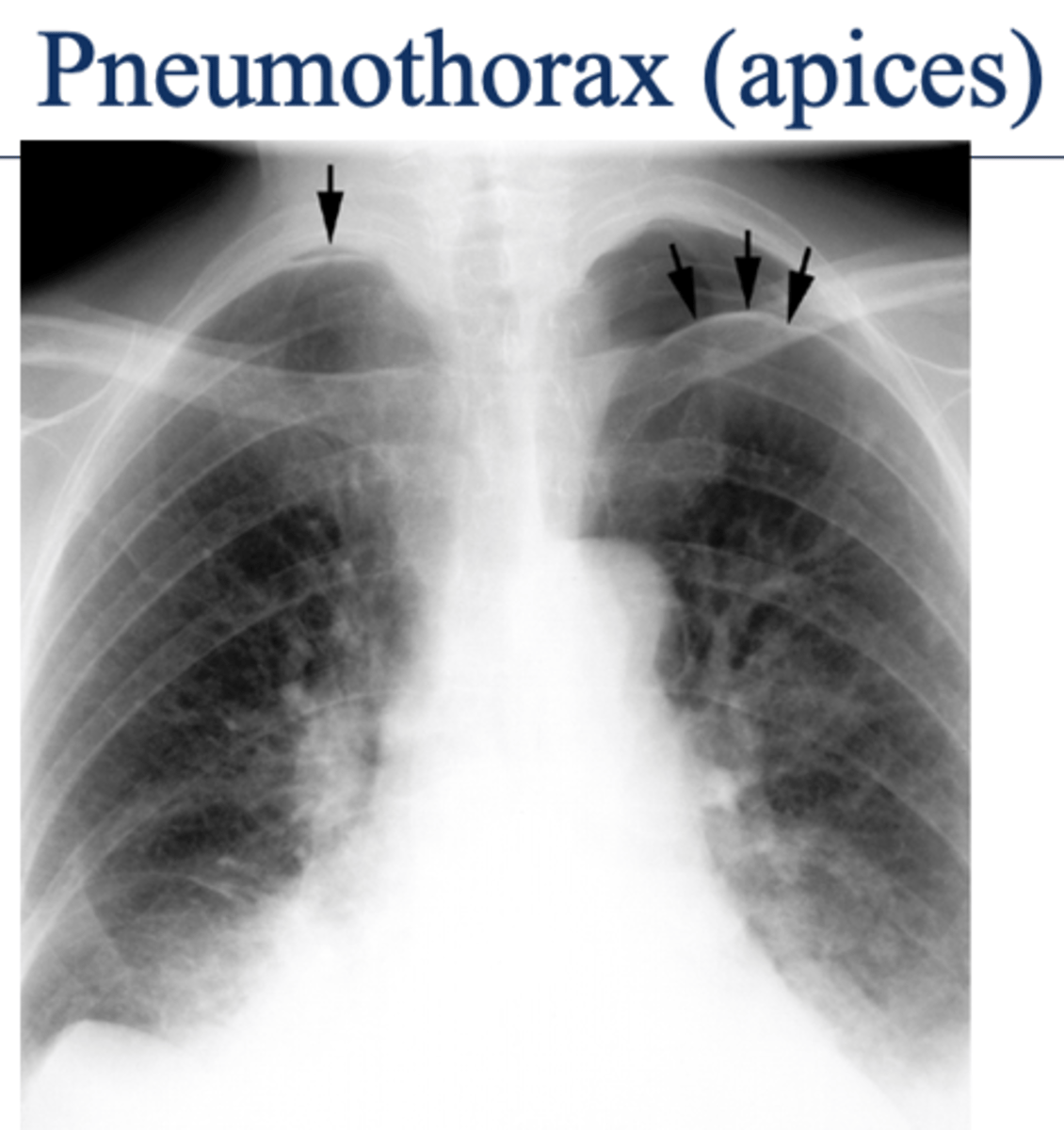 <p>What will pneumothorax look like on imaging? What area of the lungs does pneumothorax affect?</p>