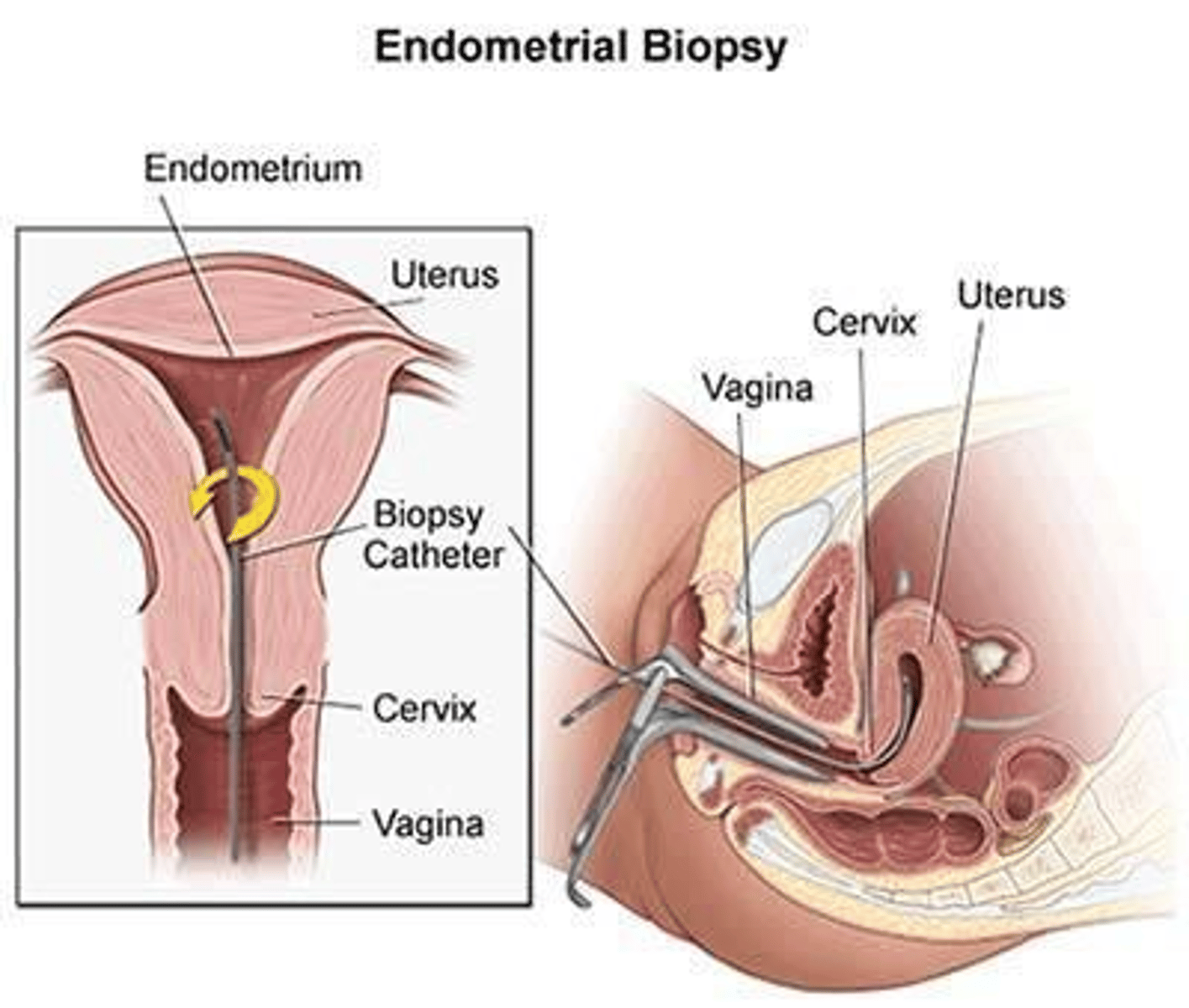 <p>Transvaginal ultrasound, confirmed with hysteroscopy and biopsy.</p>