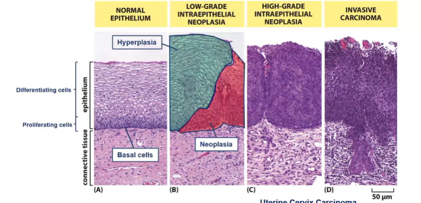 <p>Multi-step process</p><p>accumulation of increasingly abnormal cells, driven by sequential accumulation of mutations </p>
