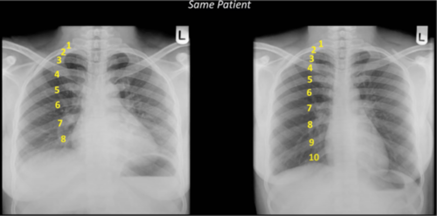 <p>-lung volumes appear falsely low</p><p>-lung markings appear falsely prominent</p><p>-cardiac silhouette and mediastinum falsely appear enlarged</p>