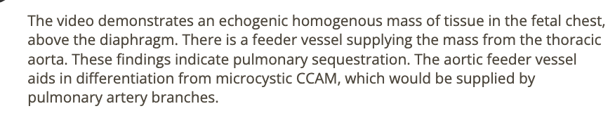 <p>b) pulmonary sequestration</p>