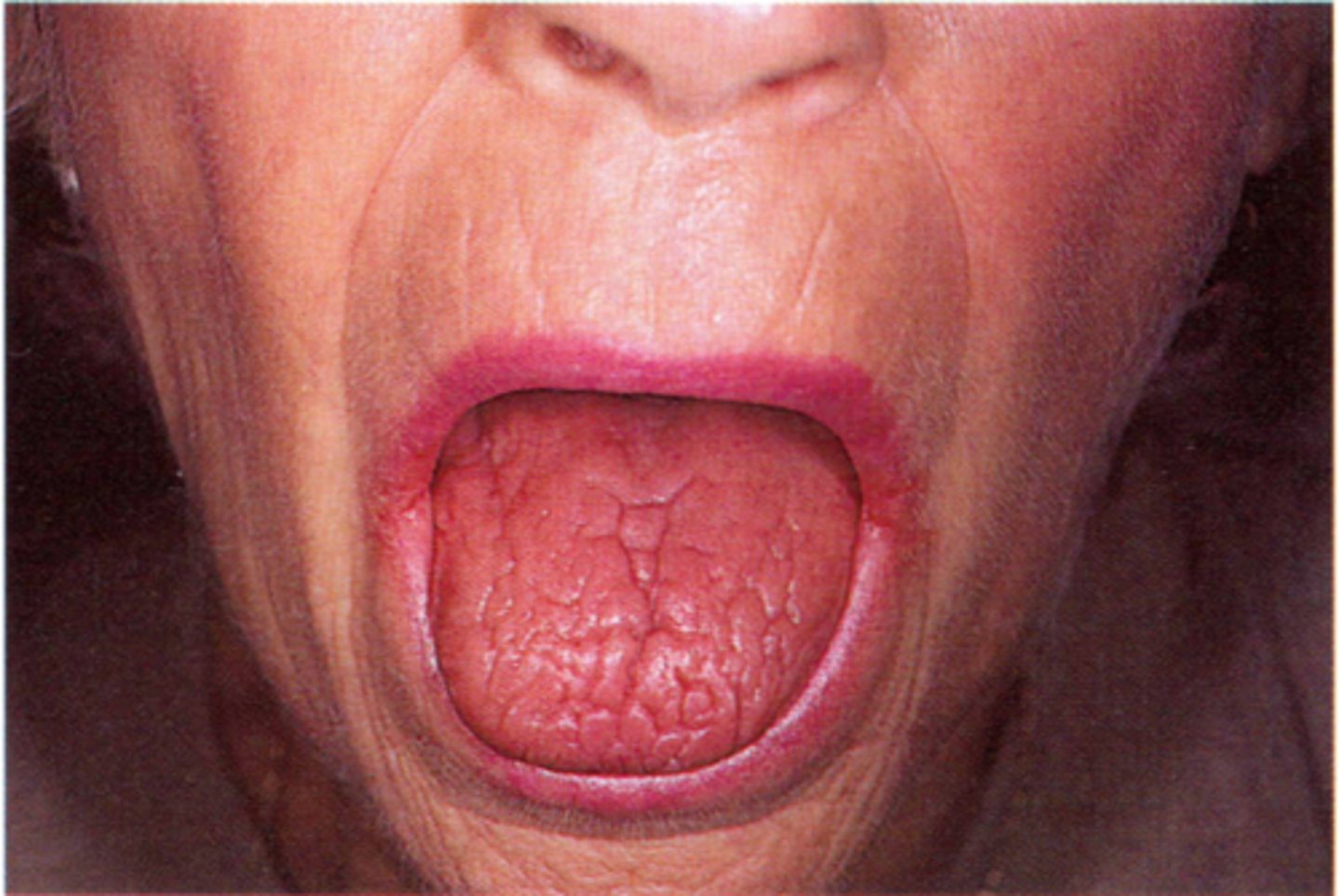 <p>autoimmune</p><p>salivary and lacrimal</p><p>dry mouth/ eyes, rampant caries</p>