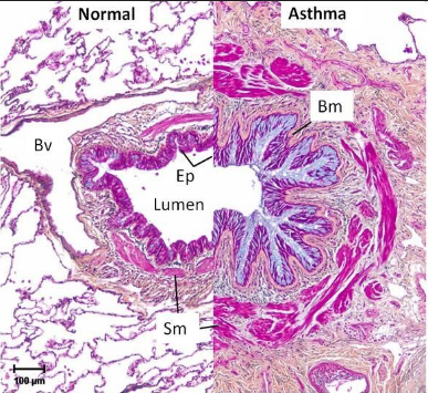 <p>what is the mechanism of asthma?</p>