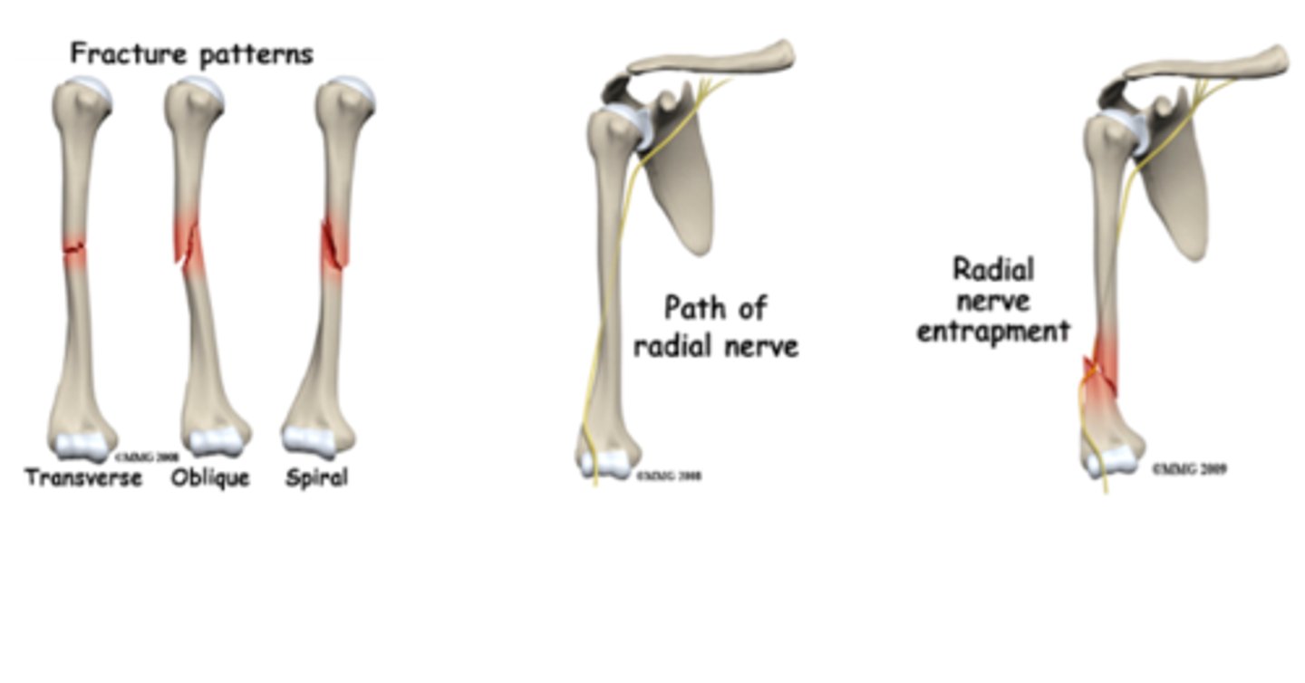 <p>radial</p><p>- will be unable to extend wrist/fingers</p><p>- lose sensation on the dorsum of the hand</p>