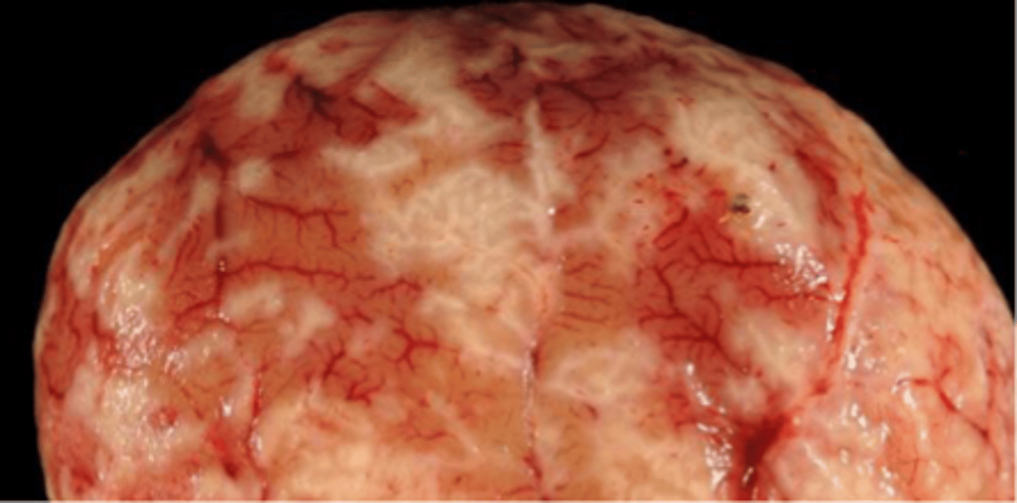 <p>Granulomatous necrotizing vasculitis</p>