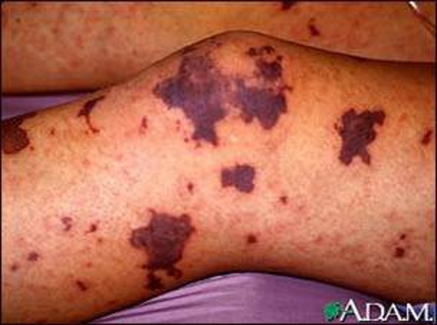 <p>Deficient number of circulating platelets</p><p>– Petechiae appear as a result of spontaneous, widespread hemorrhage</p><p>– Due to suppression or destruction of red bone marrow (examples: malignancy, radiation, or drugs)</p><p>– Platelet count <50,000/ml is diagnostic</p><p>–Treatment: transfusion of concentrated platelets</p>
