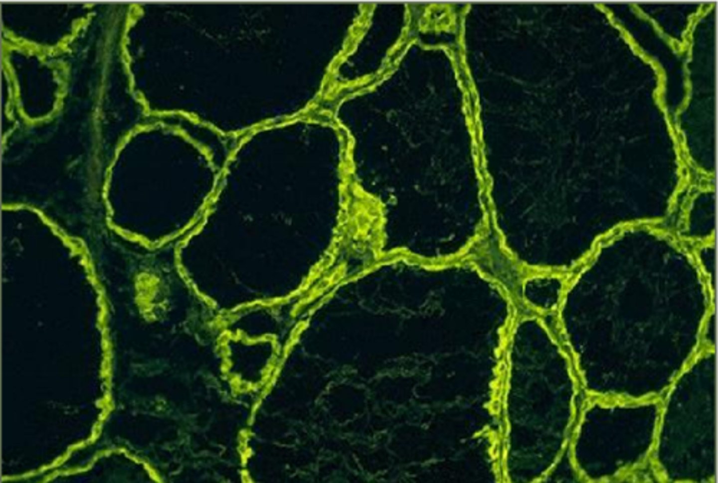 <p>This is a thyroid from a hashimotos dog under immunofluorescence. How can you tell the dog has hypothyroidism?</p>