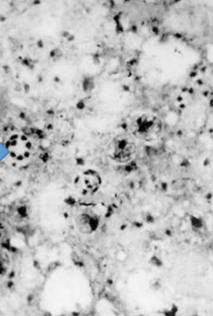 <p>What is this?</p><ul><li><p>mode of transportation</p></li><li><p>infective stage</p></li><li><p>type of fungus</p></li><li><p>can lead to?</p></li></ul><p></p>
