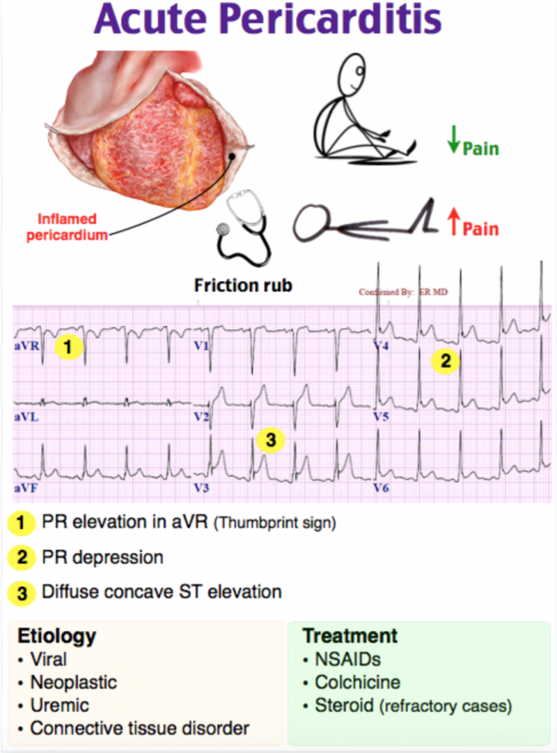 <p>Prognosis of acute pericarditis </p>