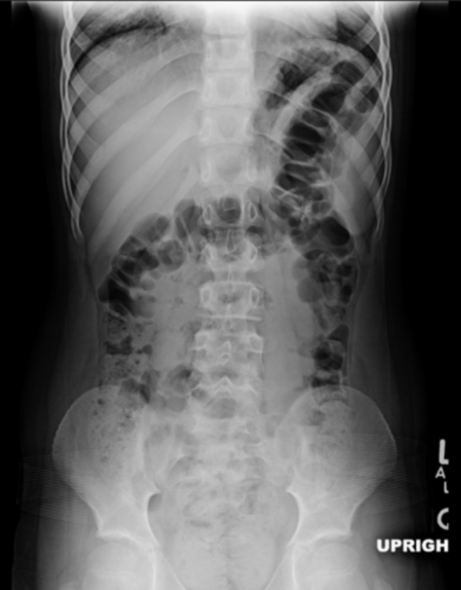 <p>normally distended bowel loops, air fills lumen completely, haustra visible</p>