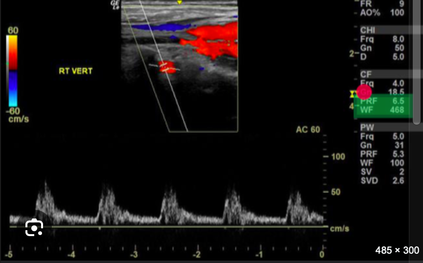 <p>Review the image and the system settings listed along the right side. Use your mouse to position your cursor over the settings that should be increased to improve the diagnostic quality of the color Doppler image. Click to set the cursor and confirm your answer. </p><p></p>