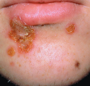 <p>What staphylococcus aureus skin infection is shown?</p>