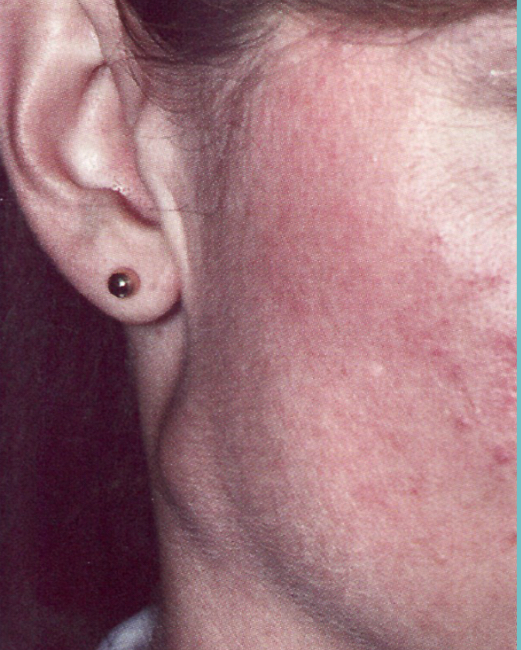 <p>Adenocarioma </p>