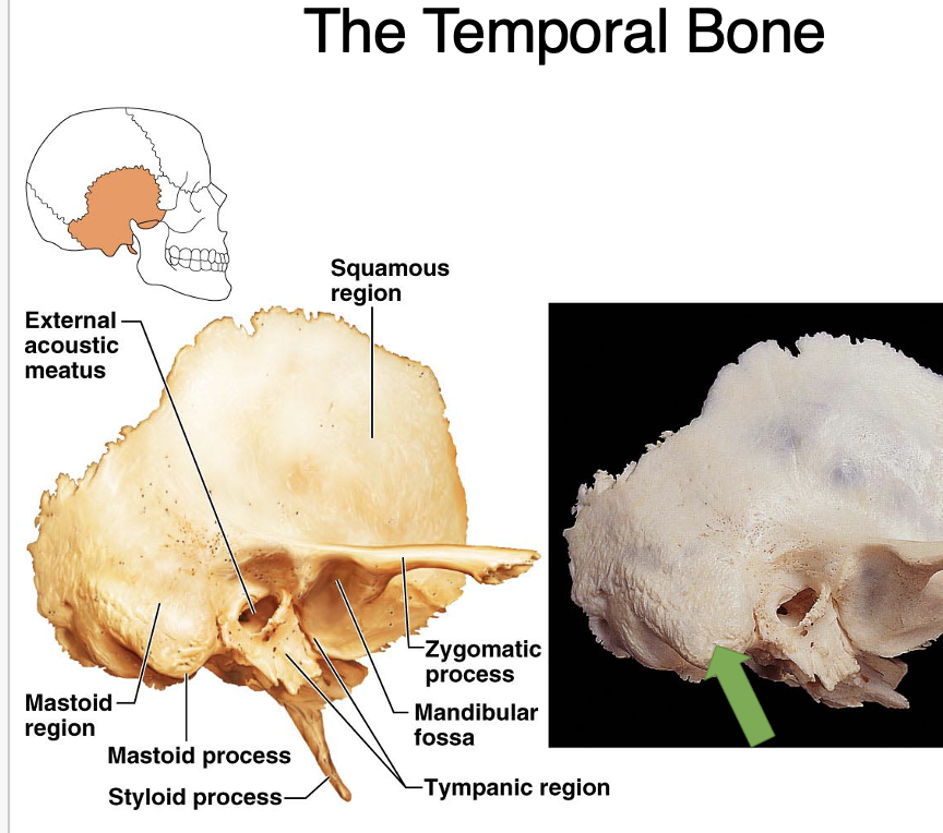 <p>temporal bone</p>