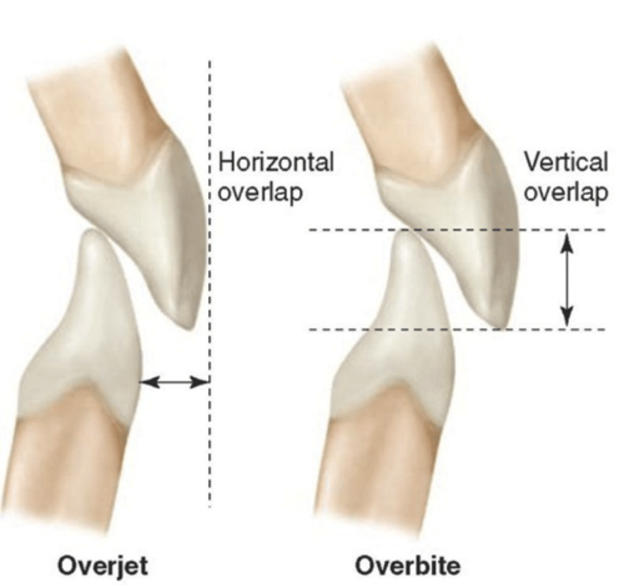<p>overbite</p>