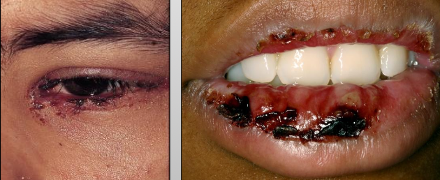 <ul><li><p>Wide spread skin lesions + 2 or more mucosal sites</p></li><li><p>(Oral + ocular or genital)</p></li><li><p>Ocular scarring may occur in severe cases (Symblepharon)</p></li><li><p>Usually due to herpes (HSV)</p></li></ul><p></p>