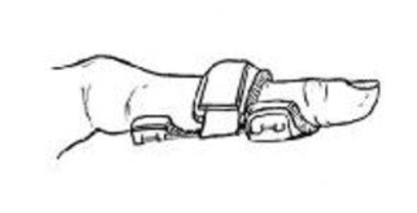 <p>Interphalangeal Boutonniere or Swan Neck Splints </p>